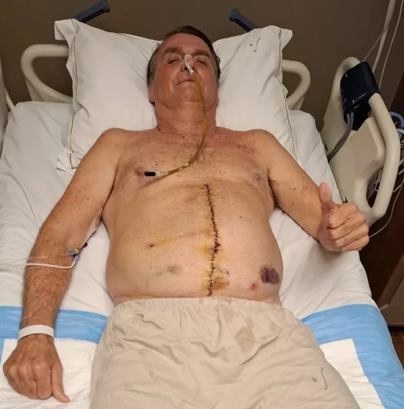 Bolsonaro: começa a surgir os primeiros sinais efetivos de movimentação intestinal.